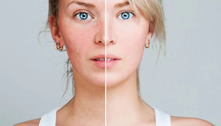 Ακμή ενηλίκων: Πώς να την αντιμετωπίσετε με αυτά τα 7 θρεπτικά στοιχεία